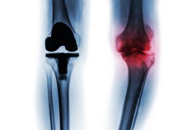 TOTAL JOINT REPLACEMENT
